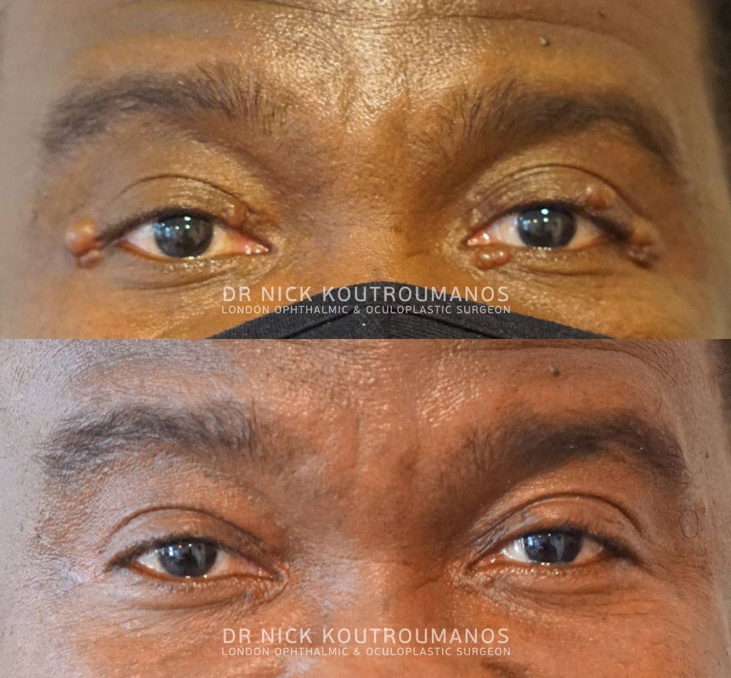 Removal of eyelid lumps