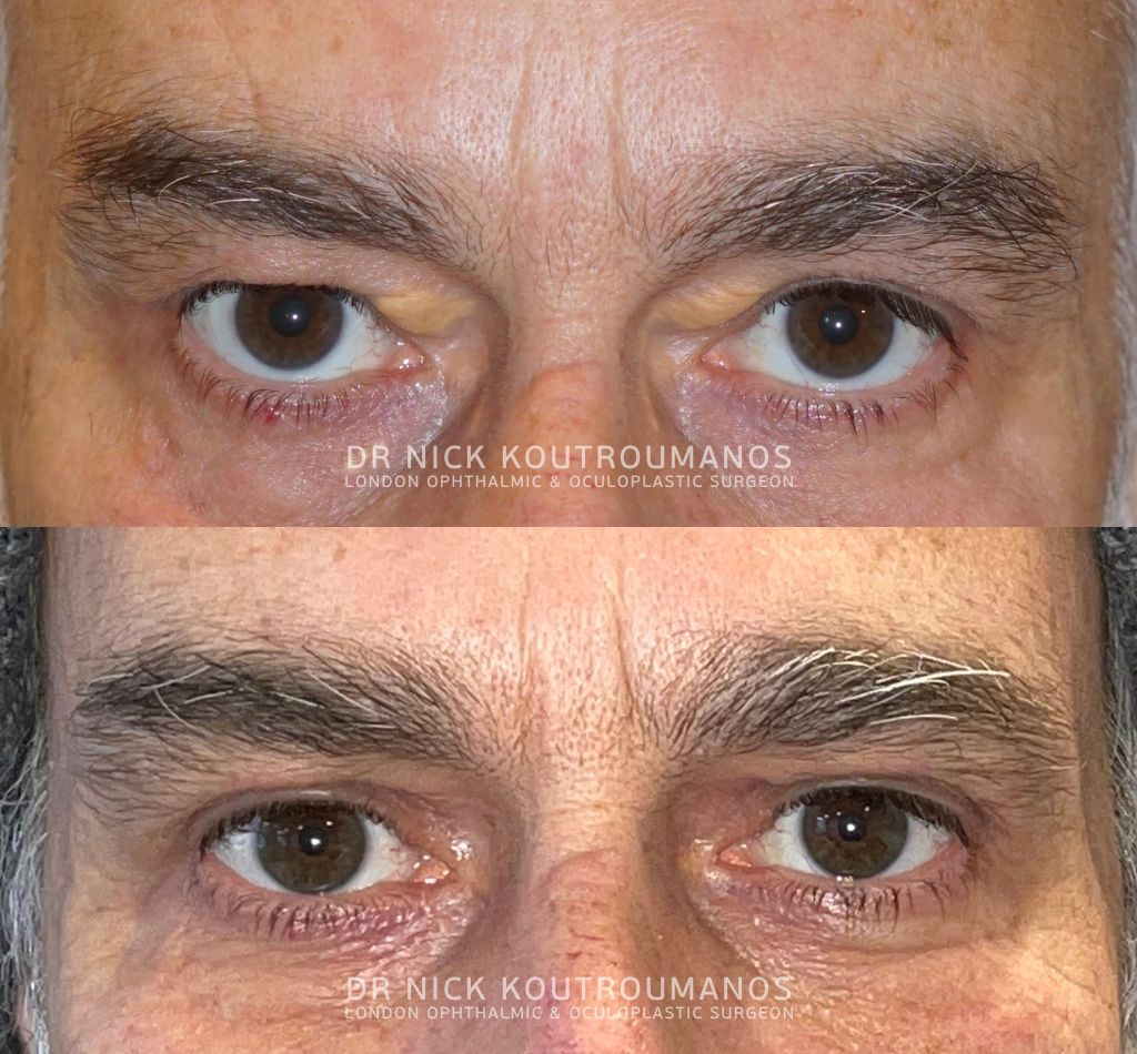Upper eyelid lift results