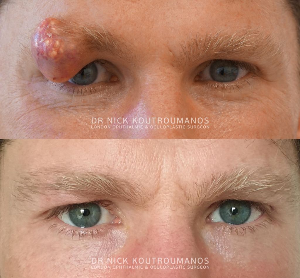 Removal of eye brow tumour