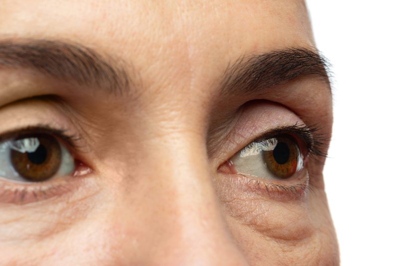 Guide to lower eyelid blepharoplasty