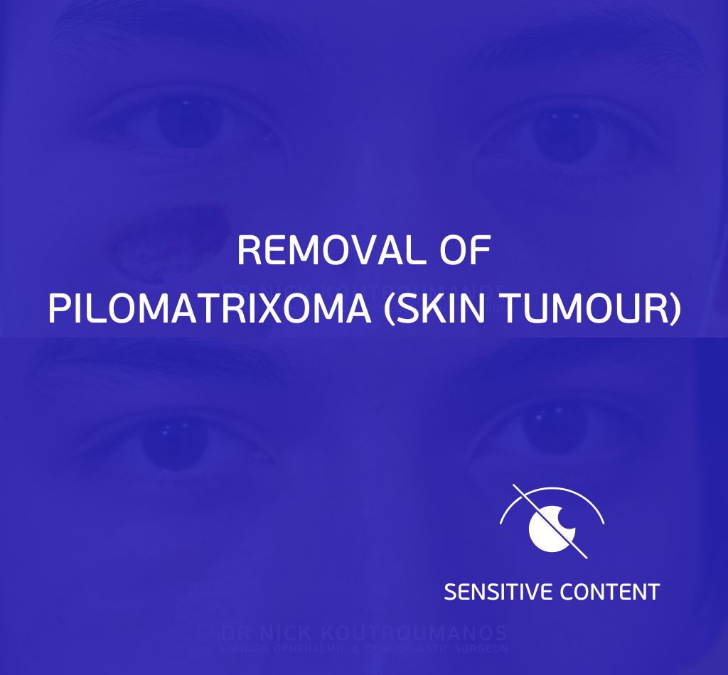 removal of pilomatrixoma