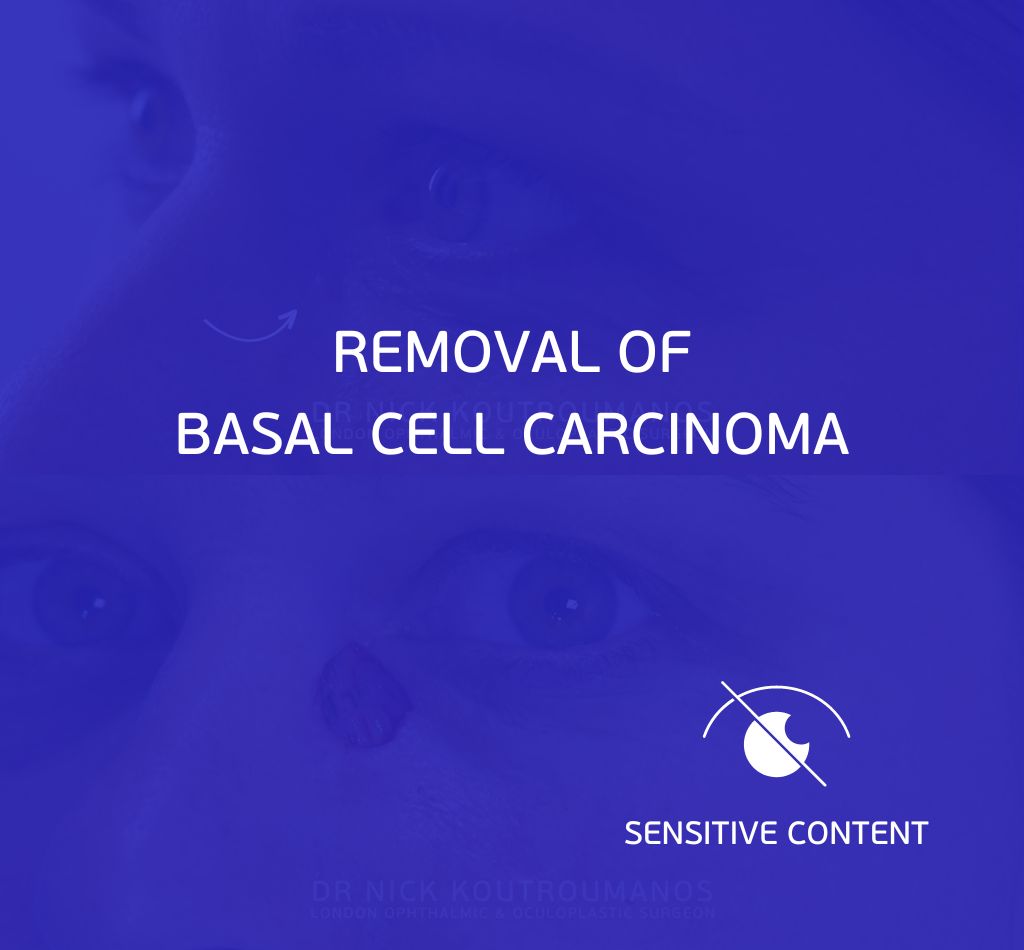 removal of basal cell carcinoma