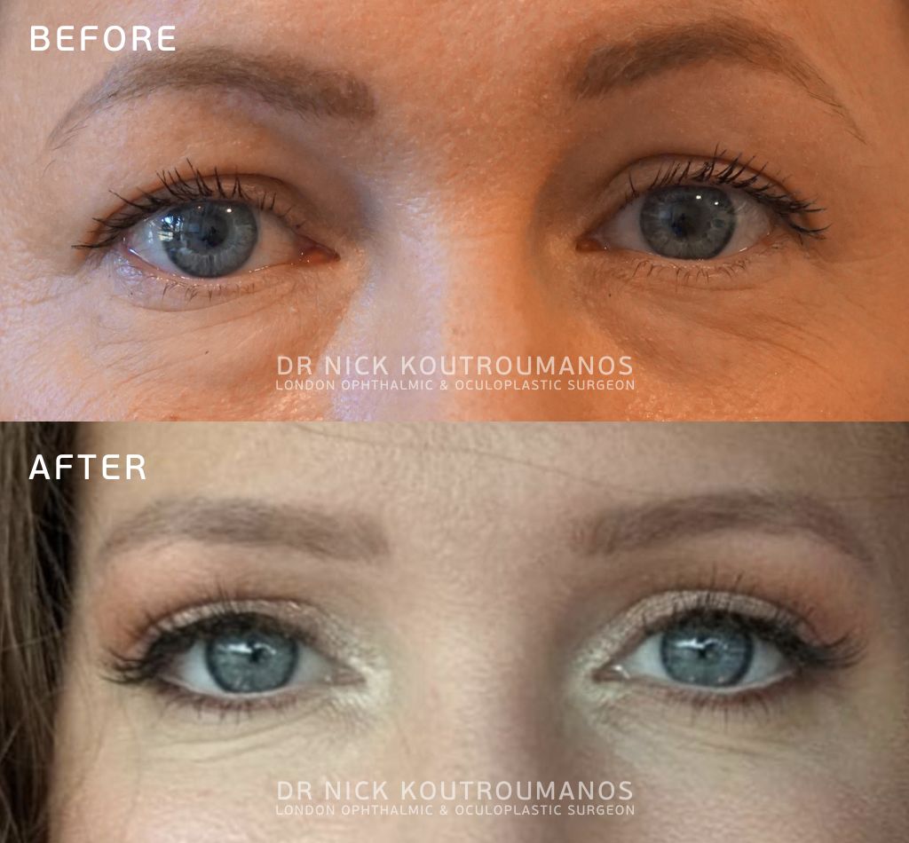 recovery after a lower eyelid lift