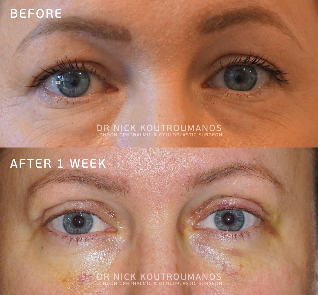 lower blepharoplasty recovery