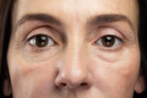 Common signs of ageing around the eye