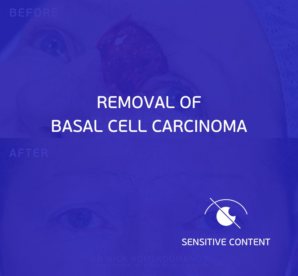 Removal of Basal Cell carcinoma