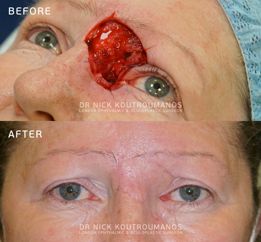 Basal Cell Carcinoma Removal on the eye