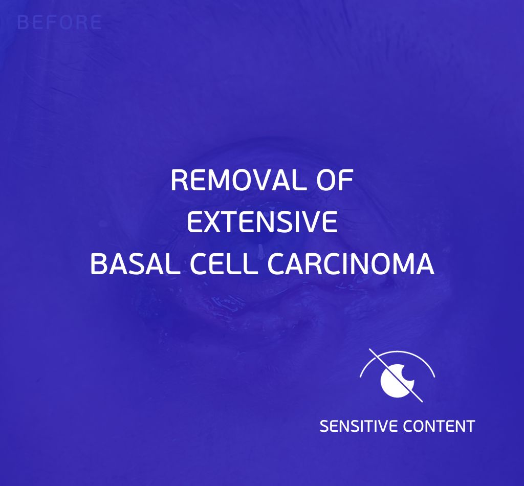 Extensive basal cell carcinoma removal