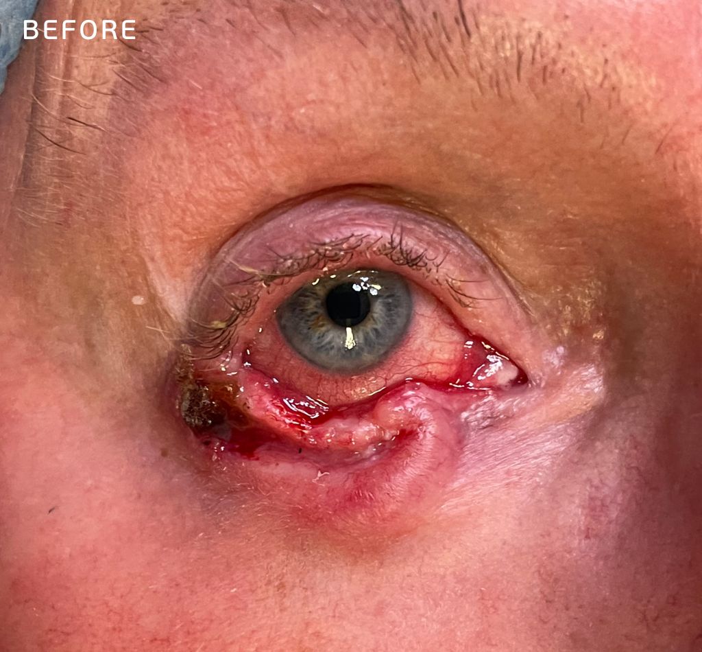 Removal of basal cell carcinoma on the eyelid