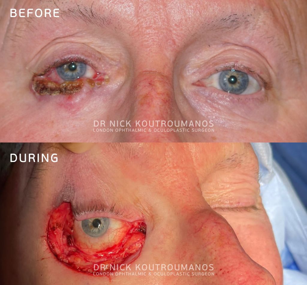 Basal cell carcinoma on the eyelid removal