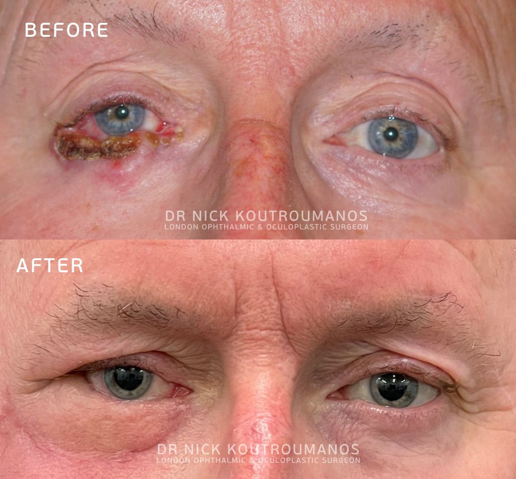 Extensive basal cell carcinoma on the eyelid