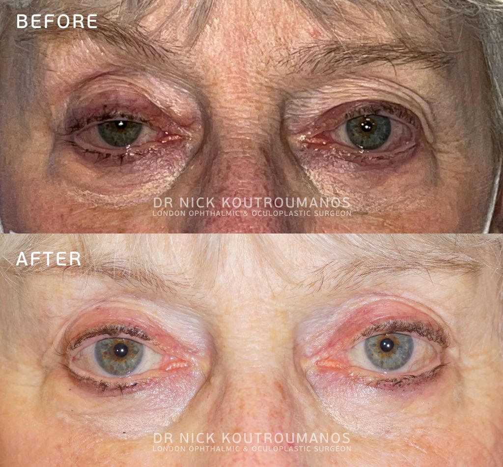 Blepharoplasty and ptosis repair combined