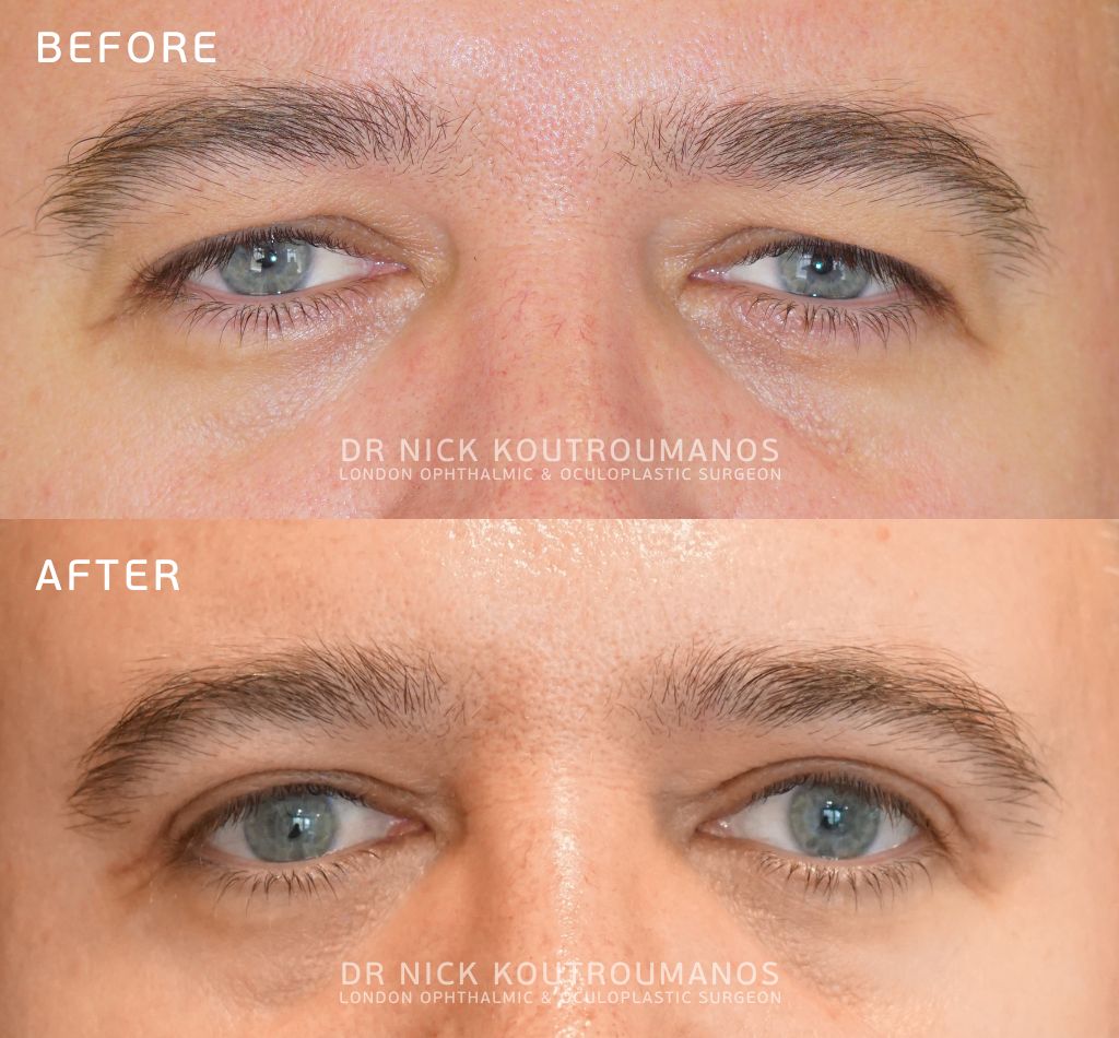 Male eyelid ptosis repair
