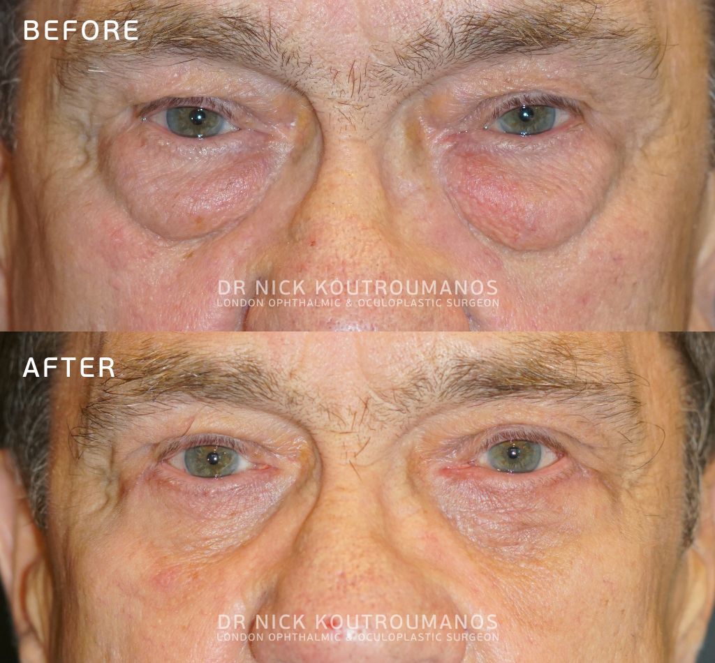 Upper and lower blepharoplasty results